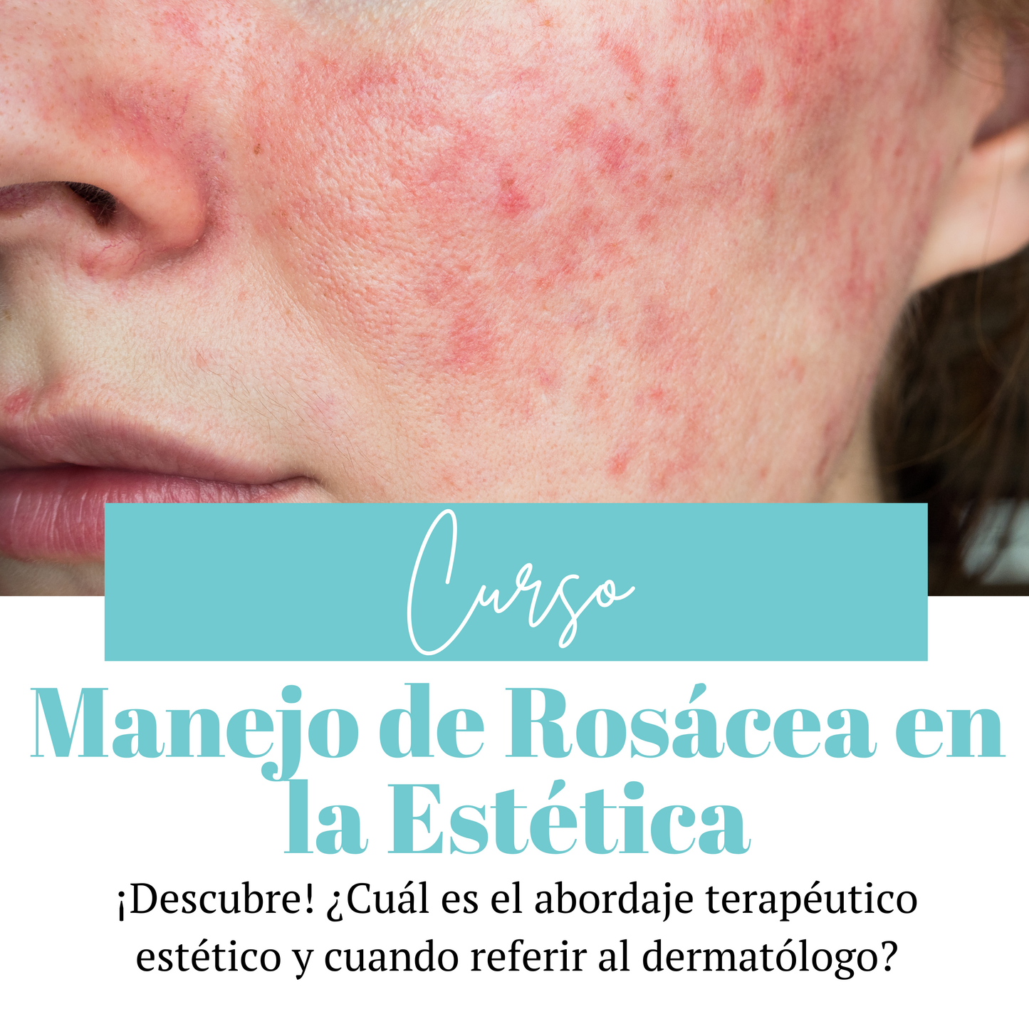 Curso | Manejo de la Rosácea en la Estética