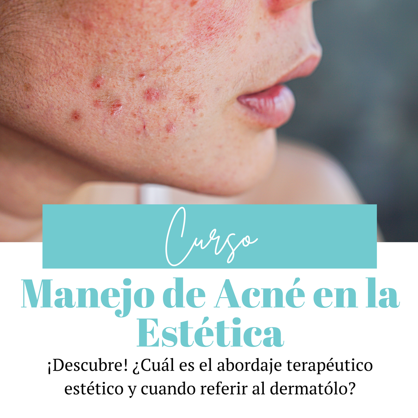 Curso | Manejo de Acné en la Estética