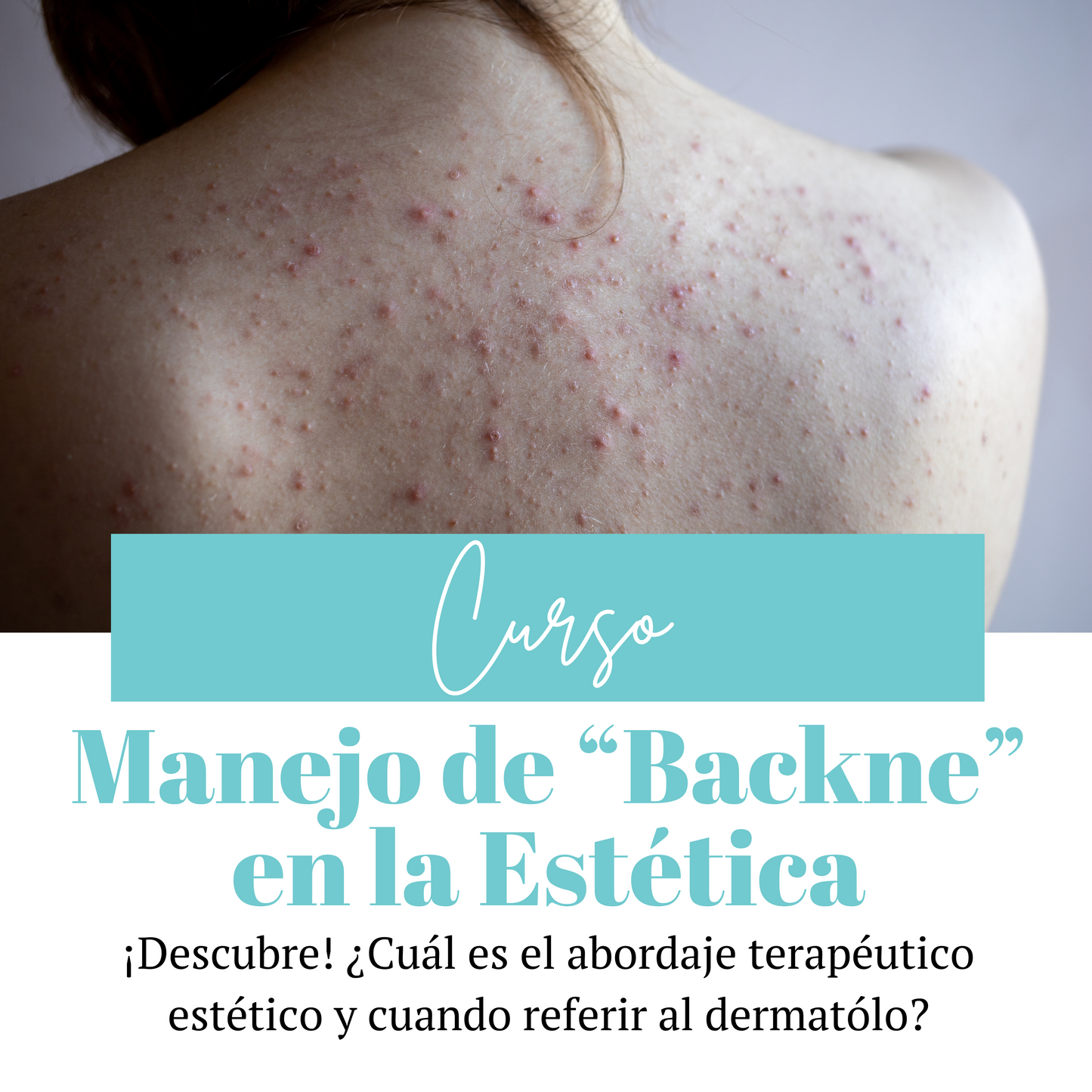 Curso | Manejo de Backne en la Estética