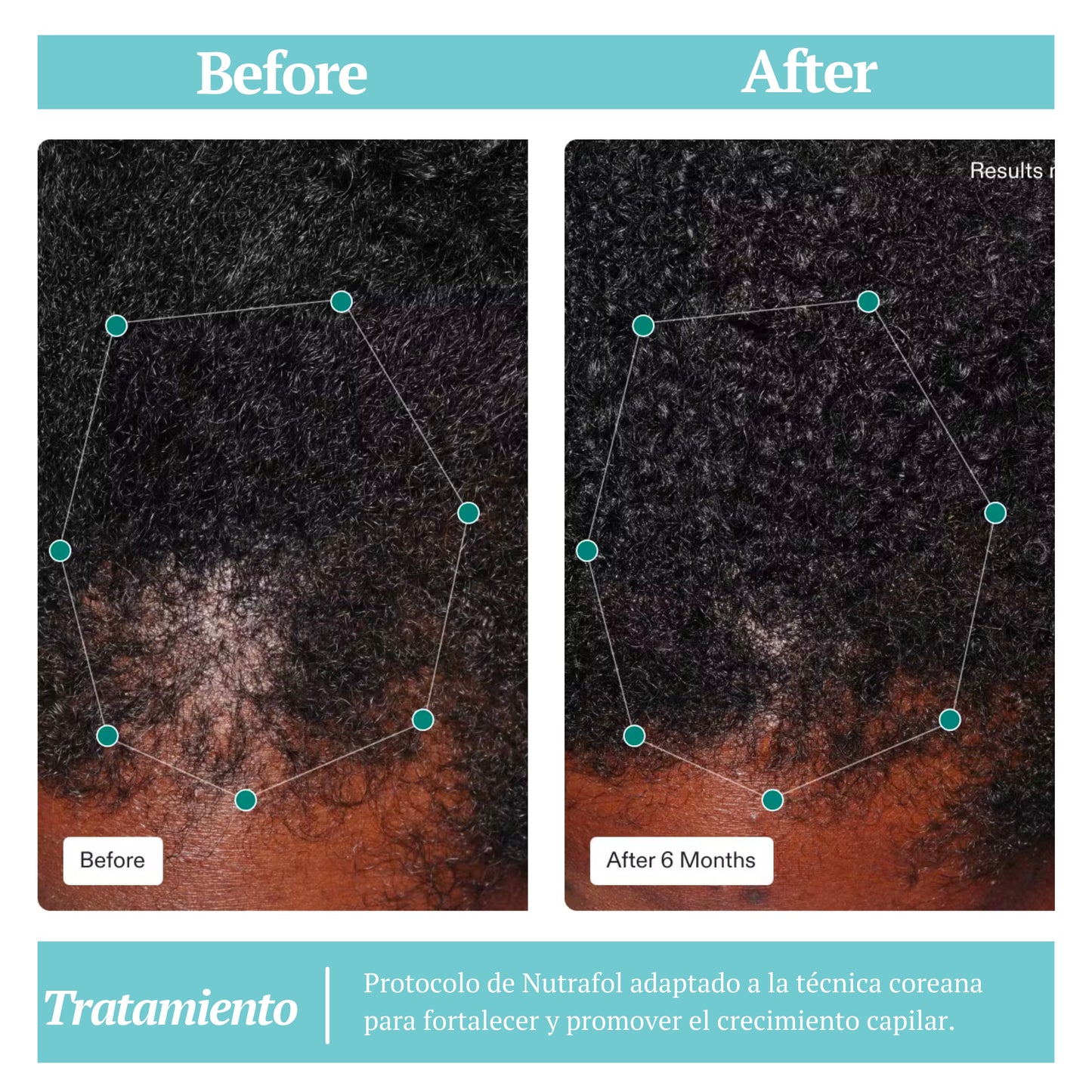 Nutrafol | Women Hair Growth Nutraceutical